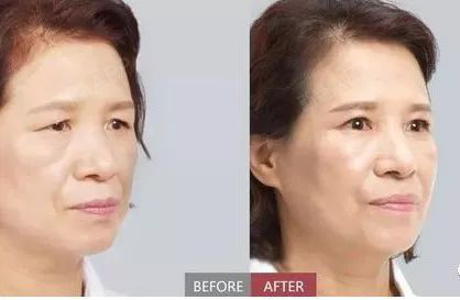 同是印第安酒窝,别人可爱你的显老,想过原因吗?