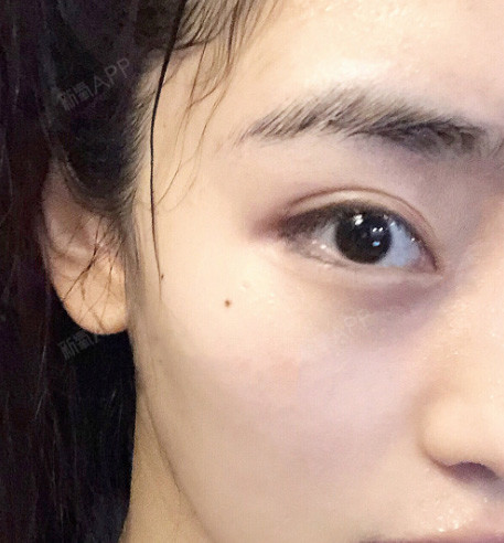 双眼皮手术 开内眼角