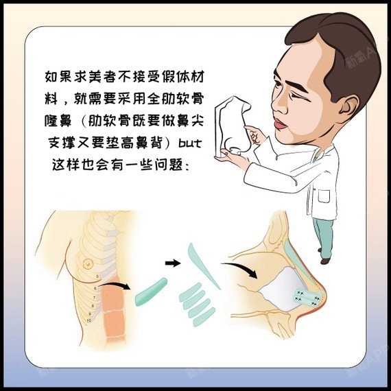 直白漫画告诉你,半肋和全肋隆鼻如何选