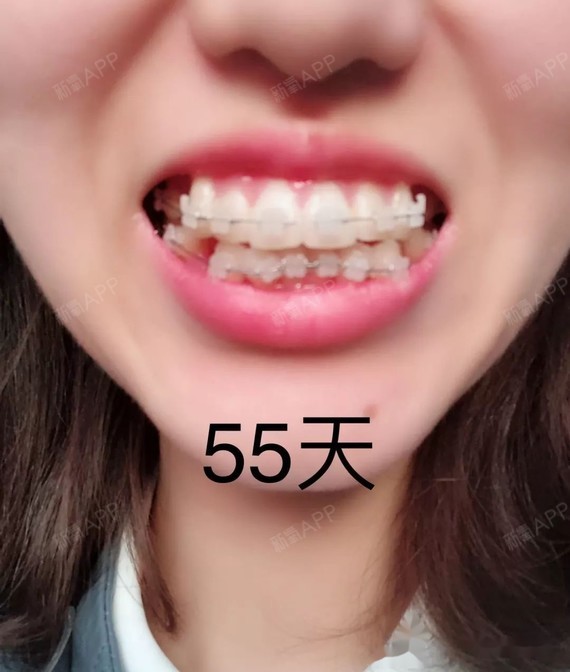 4个月牙齿矫正的对比