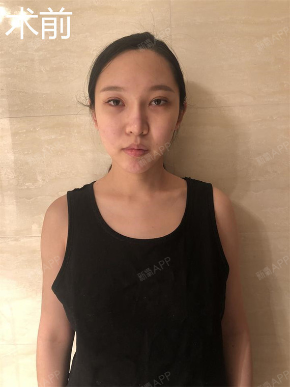自体脂肪填充的脂肪到底来自哪个部位
