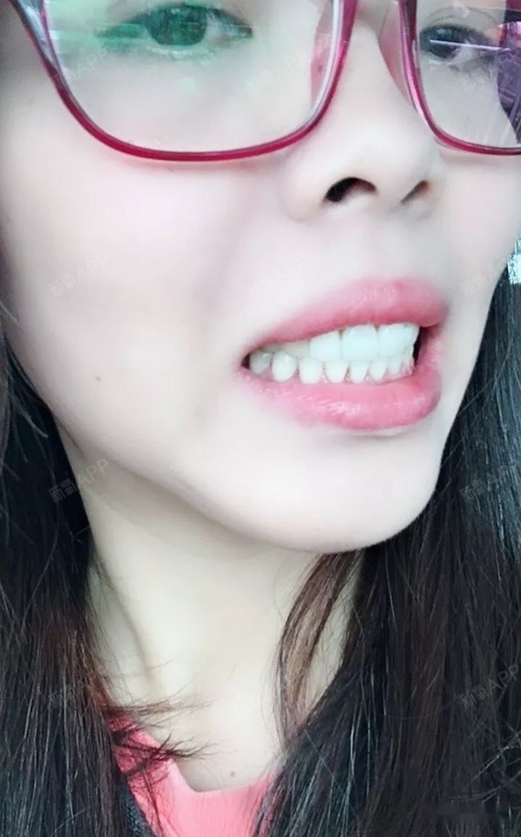 戴牙套会上瘾,嘴凸下巴后缩,484天毕业,自己满意了