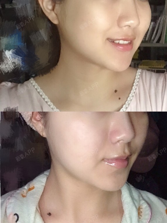 瘦脸针前后对比图!脸真的小了