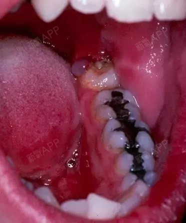 颌骨空间不足,引起的邻牙牙根吸收如果说倒在第二磨牙上被龋坏的智齿