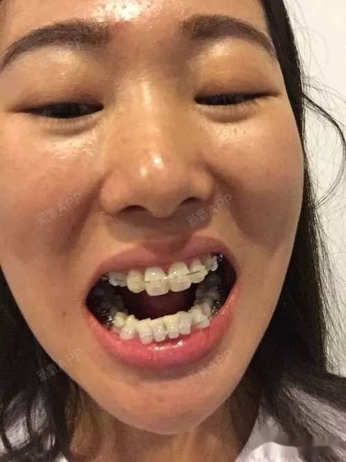 牙齿矫正