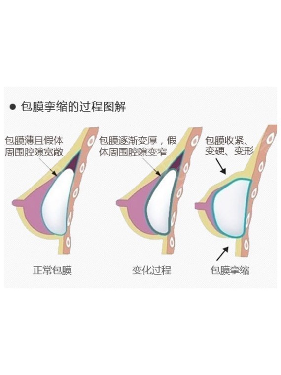 如果你都不去了解,没有预防准备,包膜挛缩假体隆胸包膜挛缩图片丰乳