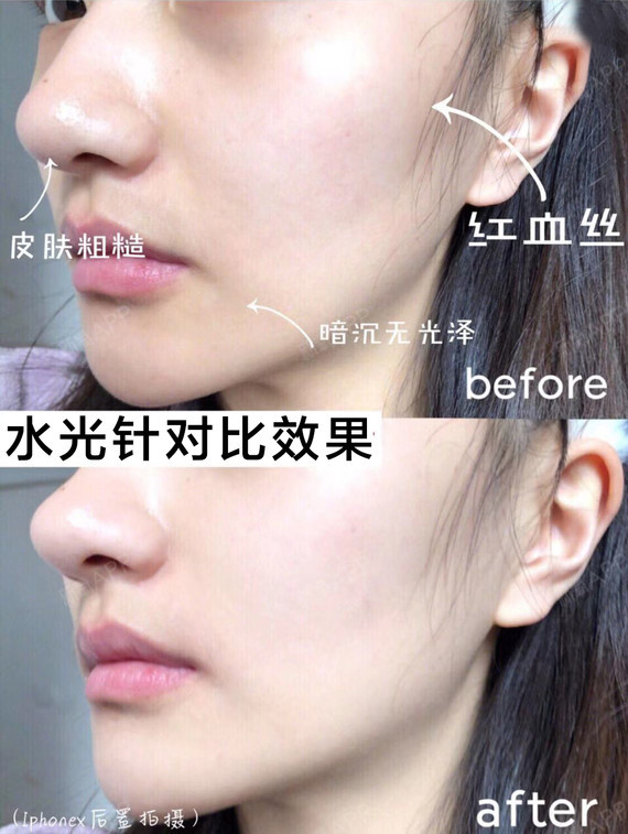 水光补水和无针水光有什么区别呢?