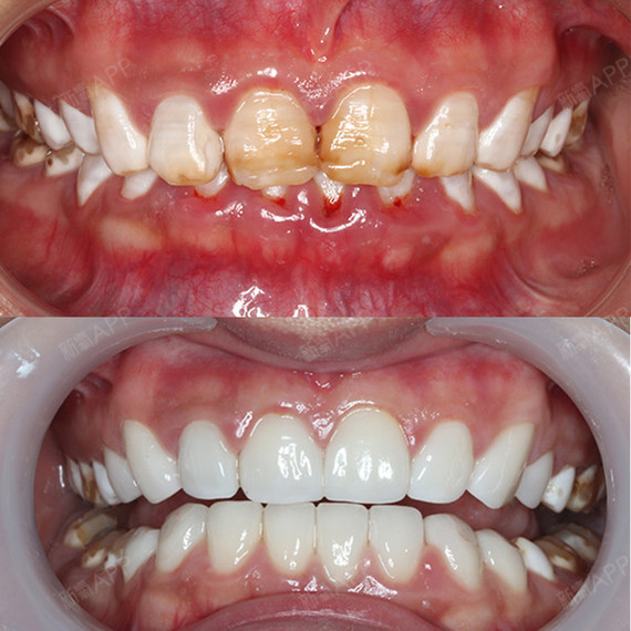 变色牙如黄牙氟斑牙四环素牙等 2.畸形牙,过小牙 3.