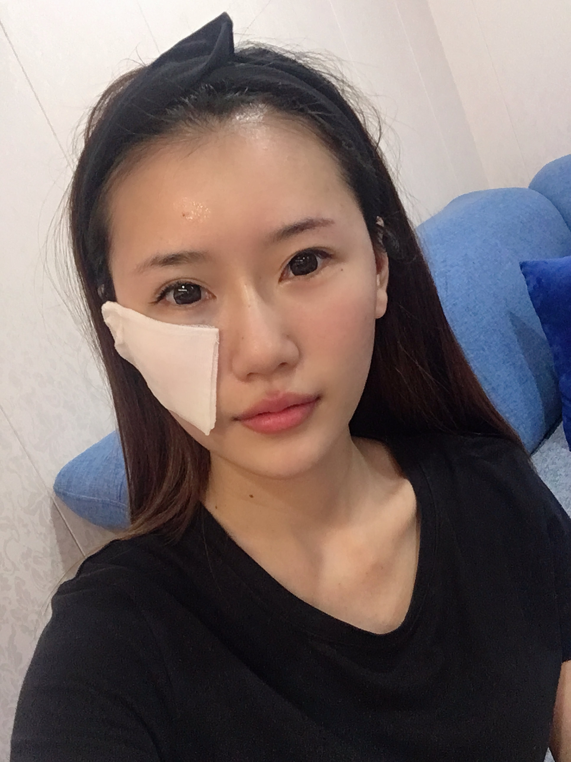 玻尿酸全脸填充第1天