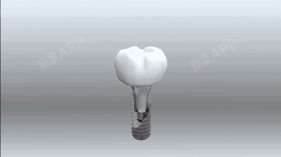 老年人有必要去做种牙吗?看完这篇你就知道了.