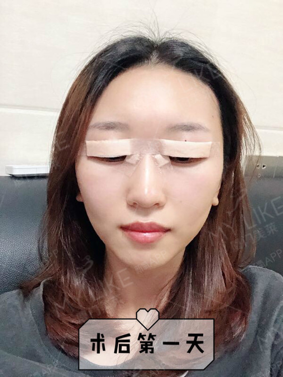开眼角会回缩吗,要怎么预防回缩呢