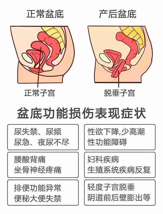 关于盆底肌,你应该知道的