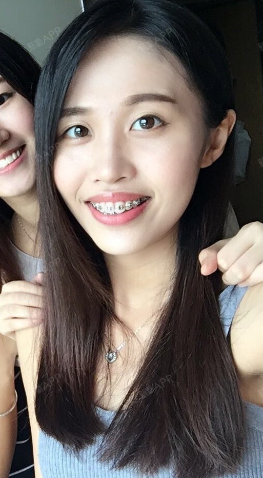 然后我妈总说,她觉得她最正确的决定就是让我去戴牙套.