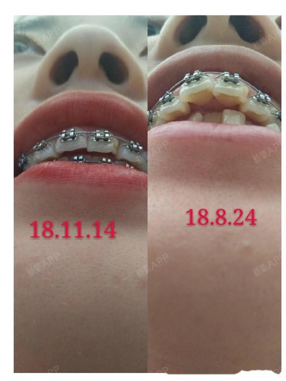 8个月,变化明显看得见,牙齿有内收整齐很多啦