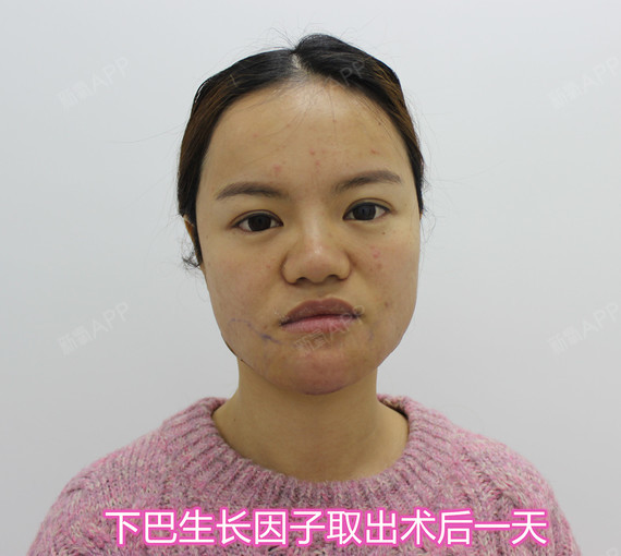 爱多邦黎星科普---注射生长因子有哪些危害?能不能取出?