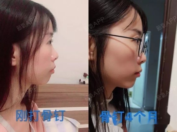 嘴凸深覆合,正脸不笑像生气,侧脸惨不忍睹.1年3个月收获满意