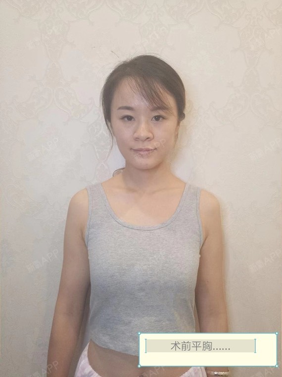自体脂肪隆胸