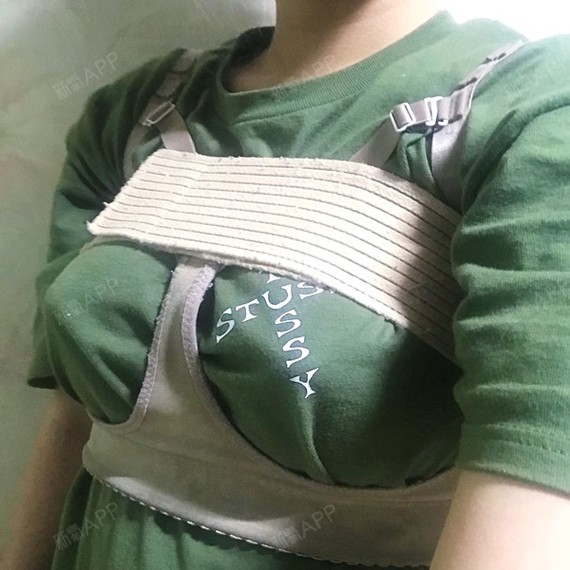 隆胸275cc效果图,曼托250cc和275效果图 做了腋下切开的隆胸手术 两边都填了蓓菈假体 275cc 手术后都要穿