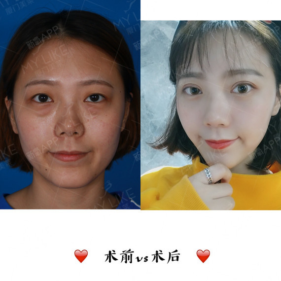 ♀为什么别人是颜值突出,我是眼球突出