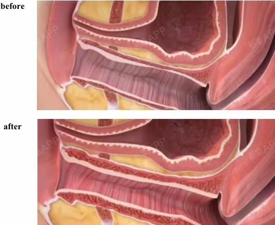 激光缩阴术加深了阴道黏膜皱褶