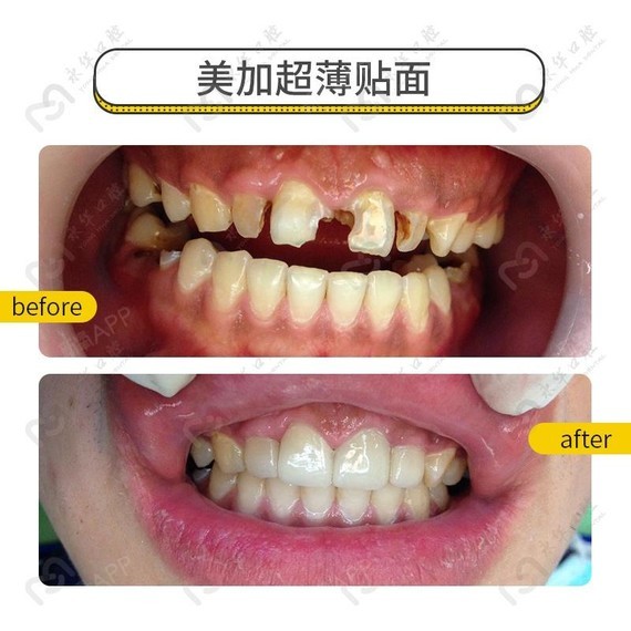 前牙龋坏——牙贴面完美修复今天给大家分享一例牙齿