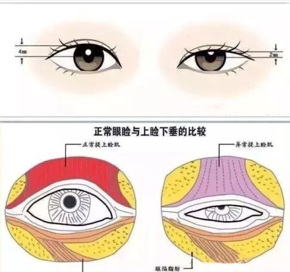 科普带你扫盲8大特征自测:你的眼睛下垂了吗?