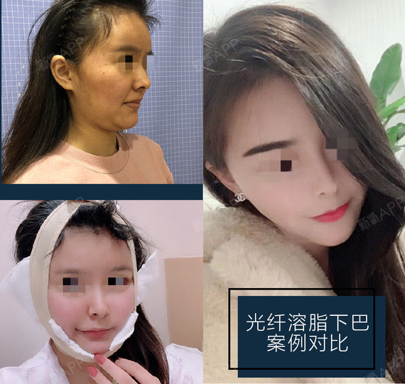 光纤溶脂让你不再惧怕双下巴!想瘦脸吗这是多少肉肉女