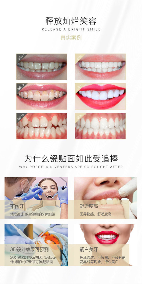 【瓷贴面】【a股上市机构】义获嘉-全瓷贴面 上市品质
