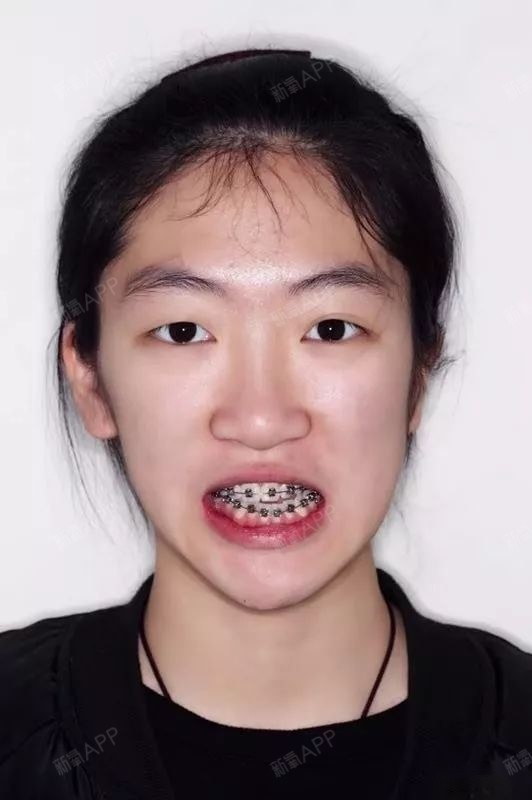 脸歪,骨性畸形,难度复杂.矫正前后变化相当大,脸型和侧貌都大大提升了