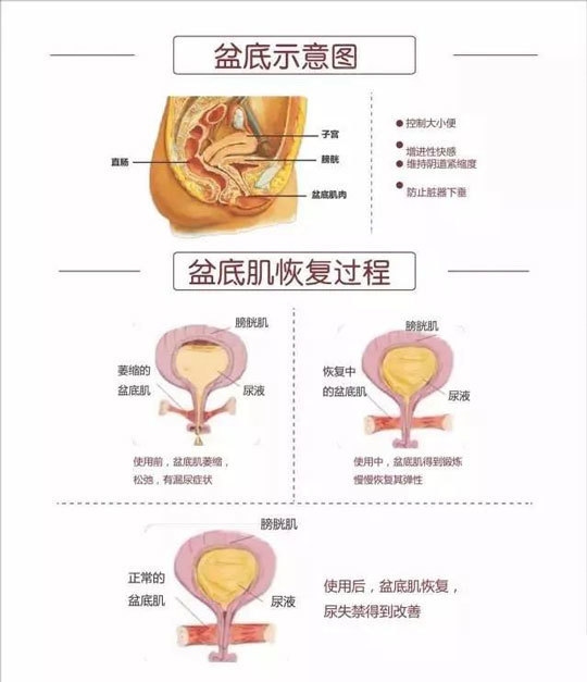 盆底肌松弛可能会导致大小便失禁,性生活质量下降,阴道膨出,子宫脱垂