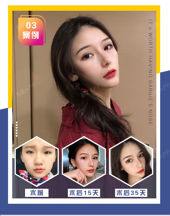 【鼻部多项【超肋鼻隆鼻术】无需取肋 双侧耳软骨镜像移植 副高级
