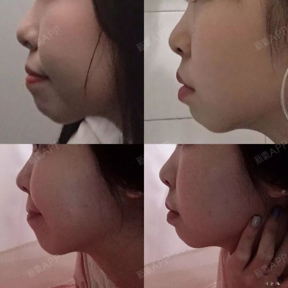 戴牙套快一年啦,侧脸嘴型变化大大