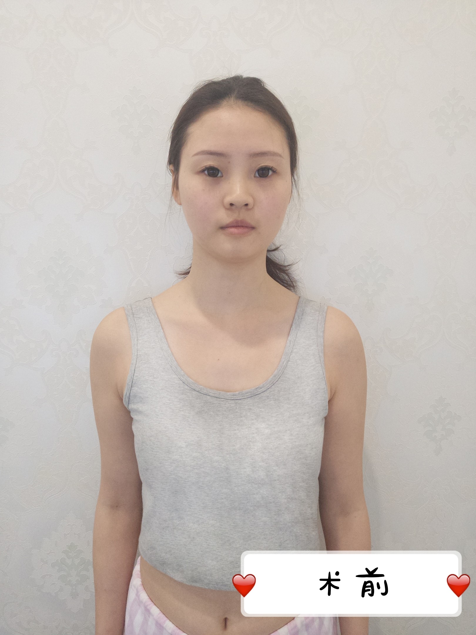结婚前隆胸一下,做最美新娘!