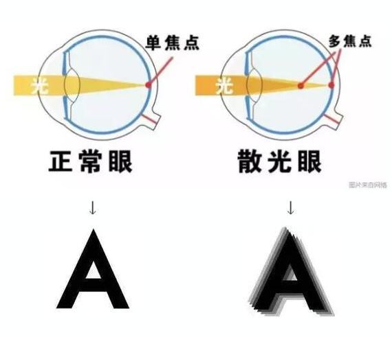 散光也能治疗?