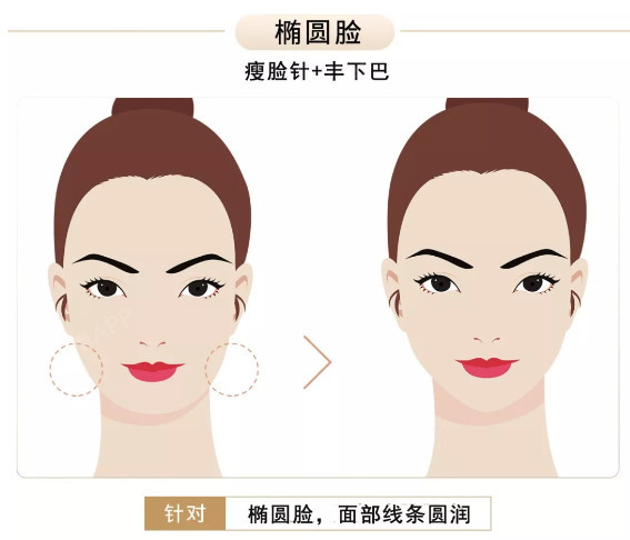 瘦脸针 丰下巴