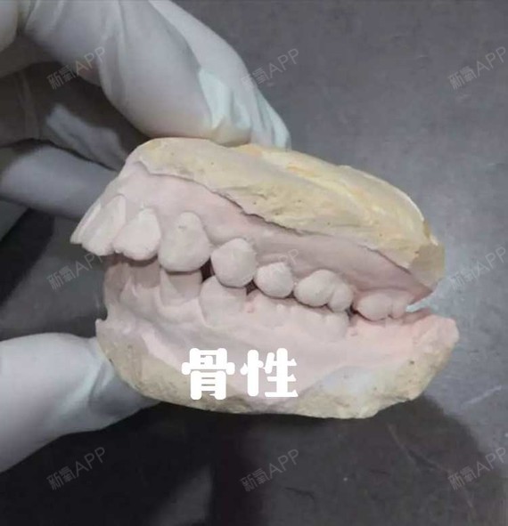 4,遗传 骨性龅牙的形成,存在基因遗传,如果父母有龅牙,那么孩子有