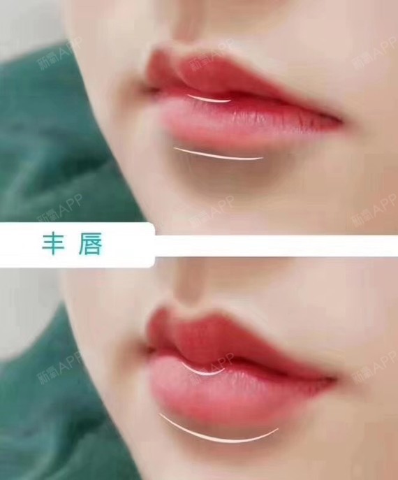 上唇下缘呈现明显的m形   嘴唇微闭微张时,唇珠特别明显       唇形