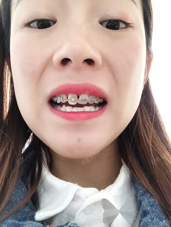 牙齿矫正