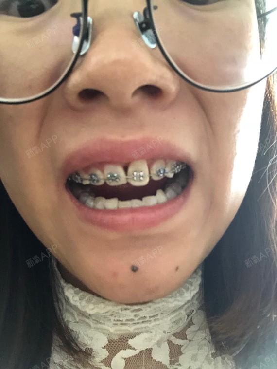 牙齿矫正
