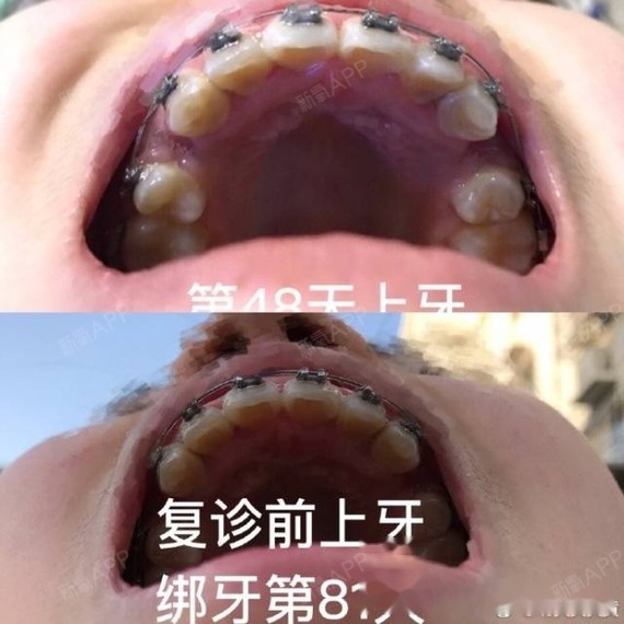 牙齿矫正