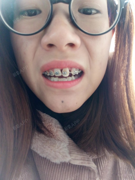 牙齿矫正