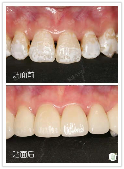 【案例分享】小姐姐氟斑牙 缝隙大,用贴面还原完美笑容!