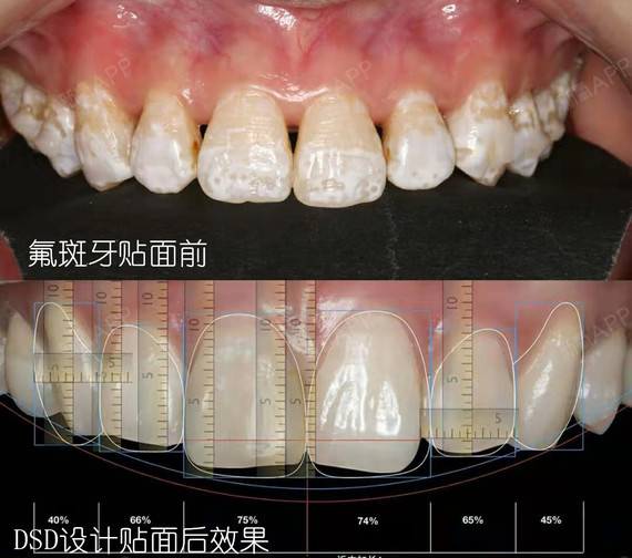 【案例分享】小姐姐氟斑牙 缝隙大,用贴面还原完美笑容!