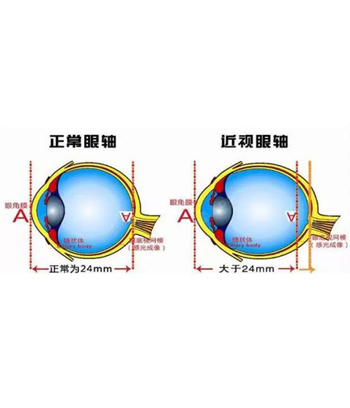 而高度近视的人,通常眼轴会比一般人长很多,便有可能表现为眼球突出