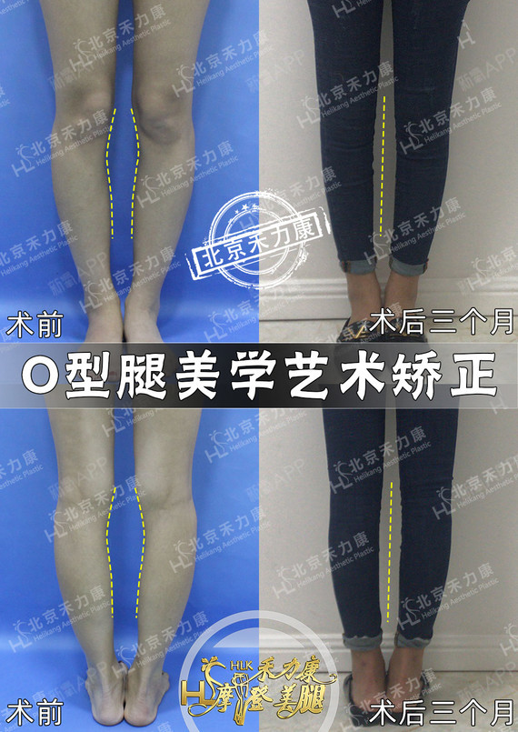 腿型矫正必看爱美是人的天性,每个女孩都想要一双又细