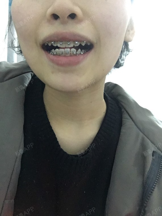 垫高一星期后我的牙齿看上去是对着的 侧面看好像上唇已经出来