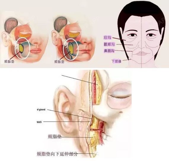 【模特案例】面部整形/面部轮廓/瘦脸/面部吸脂/去颊脂垫/取颊脂垫