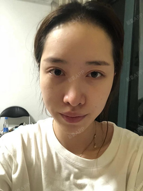 但是大家都会有疑问,隆鼻假体需要取出吗?