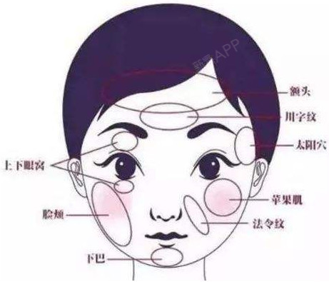 自体脂肪填充被越来越多的求美者所接受她们用脂肪填充面部太阳穴额头