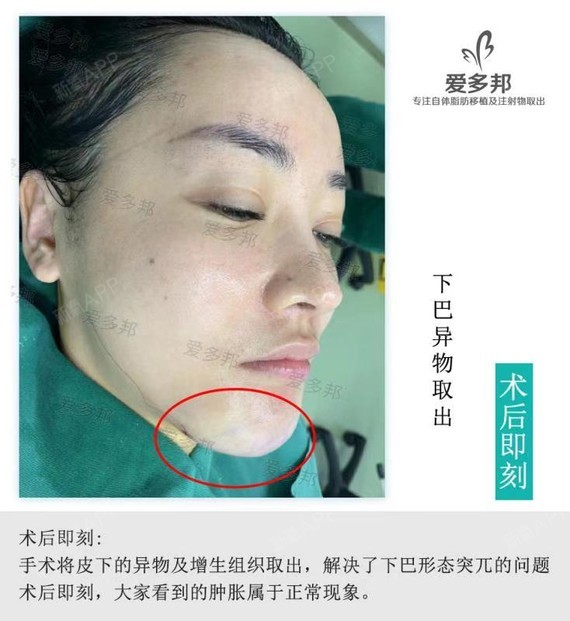 由于注射奥美定,这位女士的下巴增生变形,凹凸不平